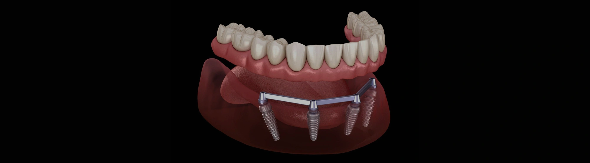Snap in Dentures Near Me Discover the Ultimate Solution for a Confident Smile